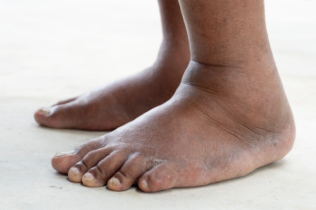 When Swelling Develops in the Feet and Ankles