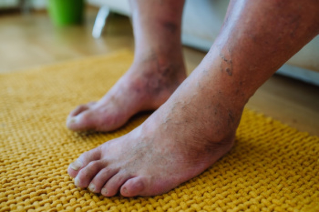 How Weight Affects Diabetic Foot Health