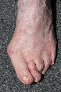 Where Does a Bunion Develop?